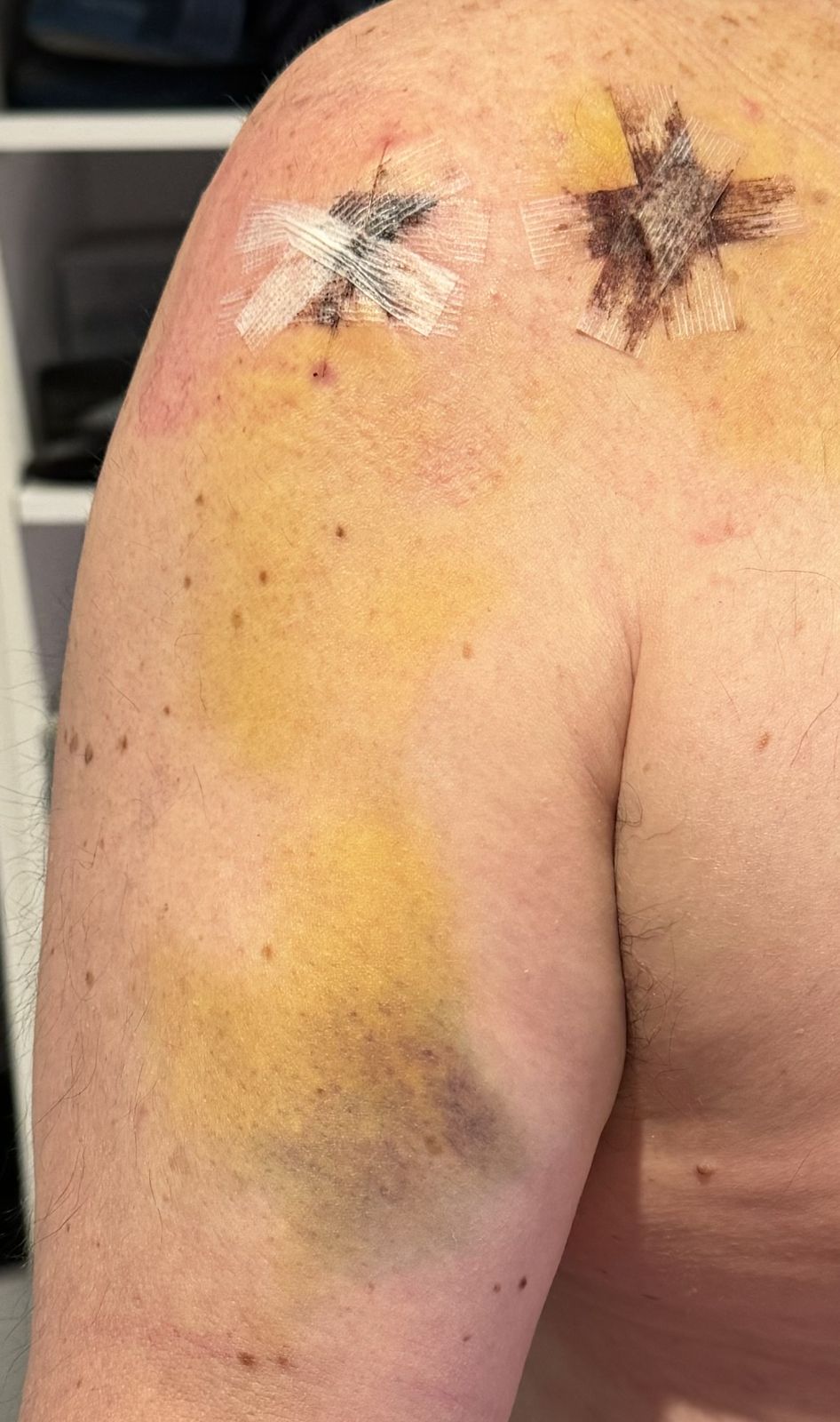 Michales right shoulder.  two wounds can be seen which show stitches and coverings of tape.  michael's bicep can be seen with severe yellow and black bruising.