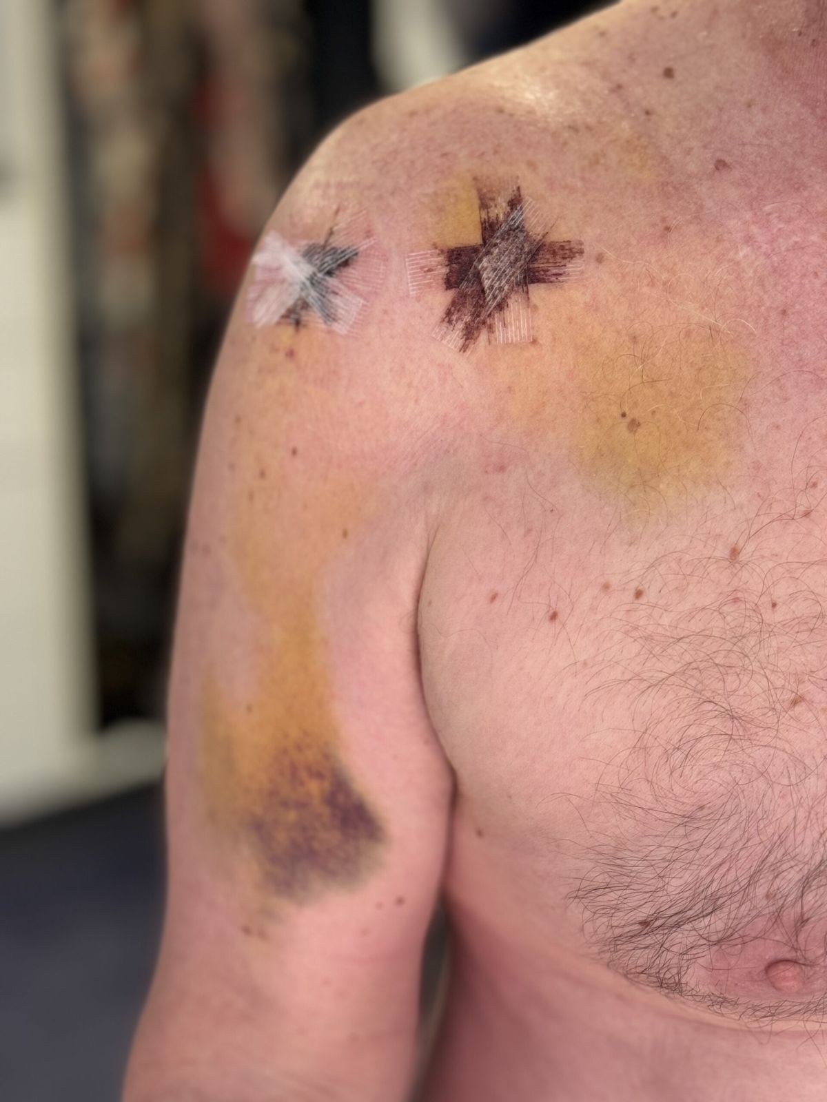 From weightlifting to winging it, my shoulder saga, week two