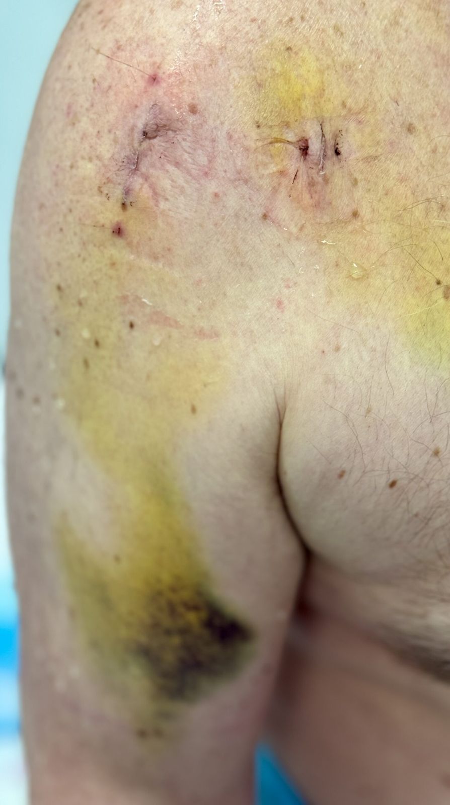 image of Michaels right shoulder with wounds where he had surgery andbrusing on his bicep